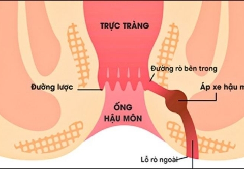 Những biến chứng nếu rò hậu môn không được điều trị kịp thời
